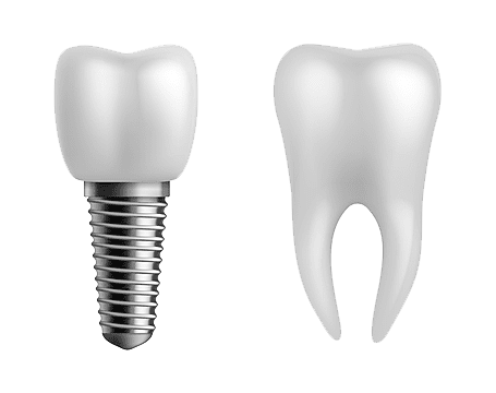 ایمپلنت دندان