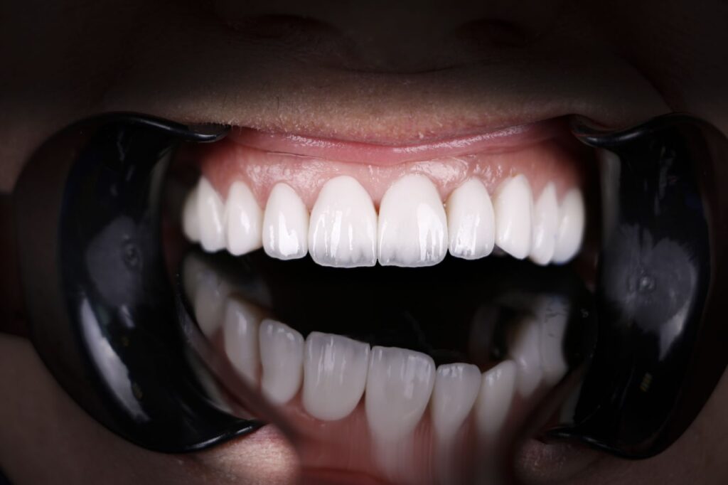 لمینت دندان چیست ؟