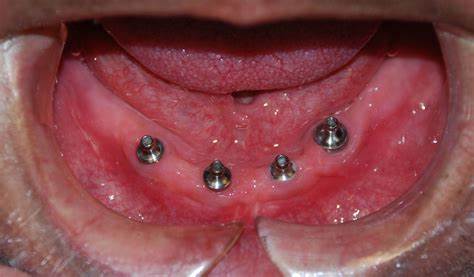 هزینه ایمپلنت دندان در سال 1402 در کرج