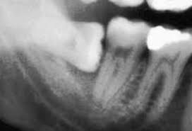 درد دندان عقل