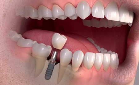 هزینه ایمپلنت در کرج چگونه است