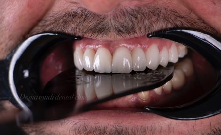 قیمت لمینت دندان سال 1400