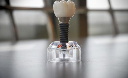 ایمپلنت دندان در کرج