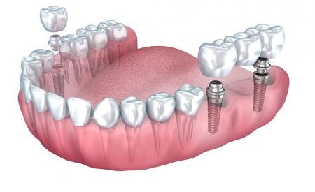 مراقبت های بعد از ایمپلنت دندان