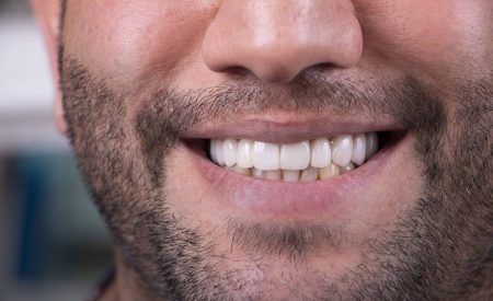 -لمینت سرامیکی E_MAX نمونه کار