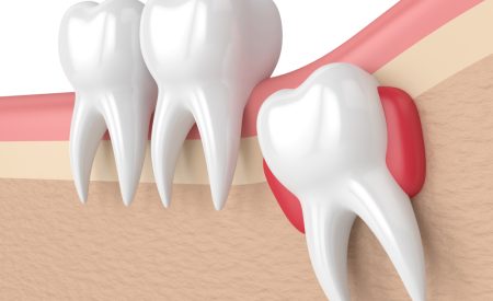 wisdom-teeth in karaj